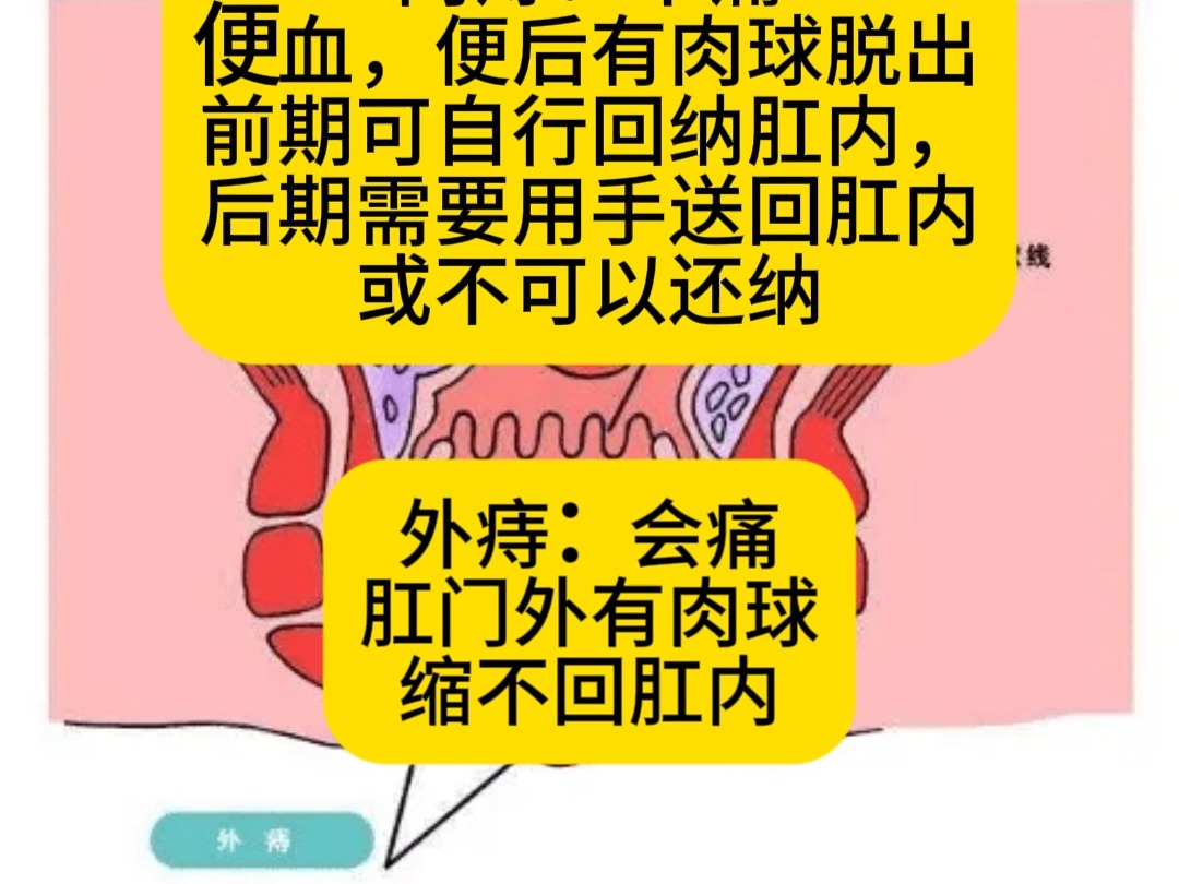痔疮什么症状