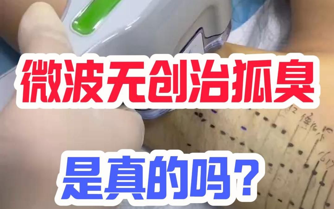 微波无创治狐臭是真的吗？