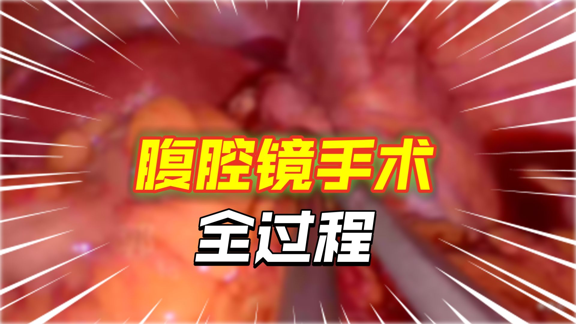 宫外孕术中发现盆腔粘连，对侧输卵管闭锁
