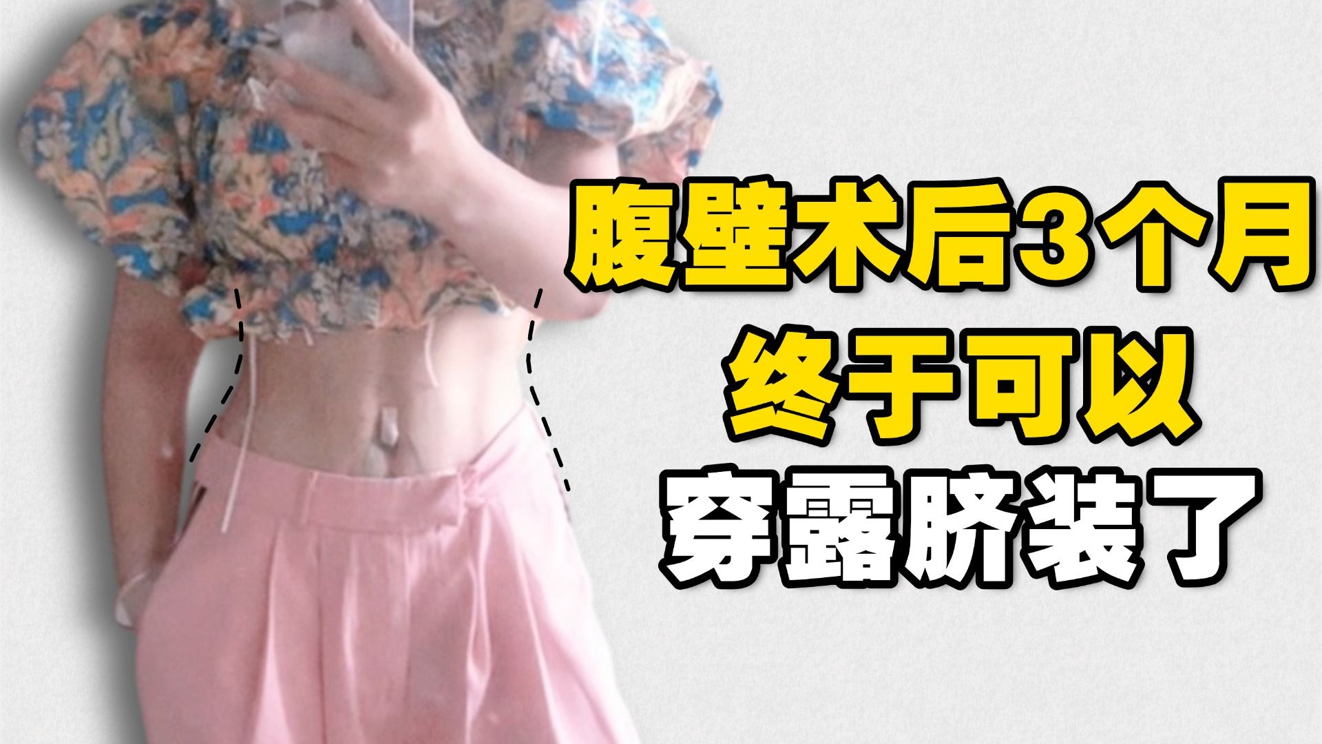 48岁宝妈腹壁术后3个月终于能穿露脐装了