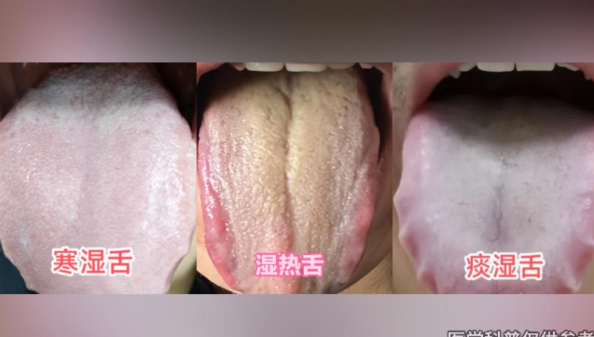 湿气重，百病生，寒湿和湿热？一看舌头全懂了，对症除湿，事半功倍！
