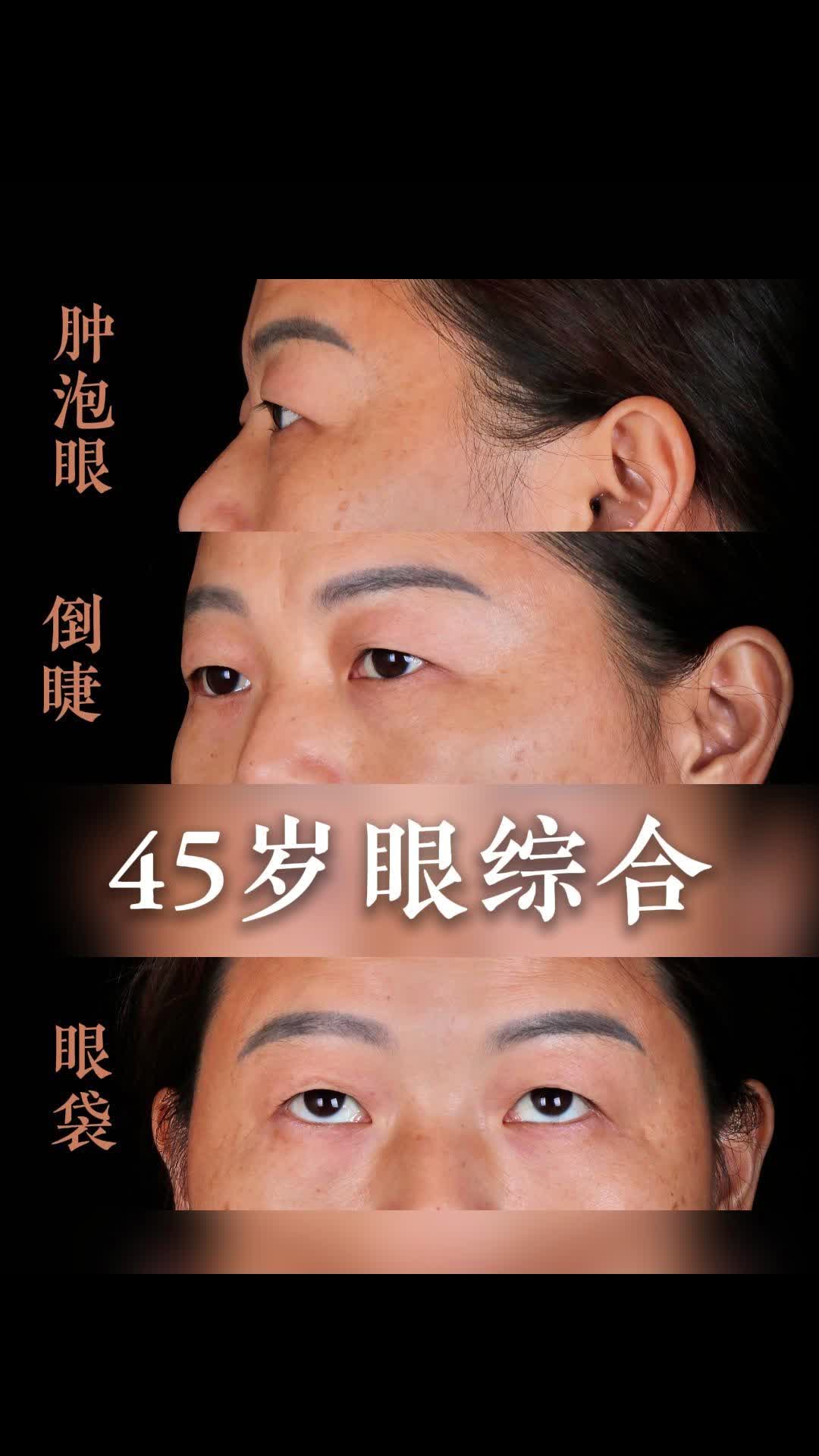 45岁想改善眼部问题，肿泡眼、眼袋，倒睫也困扰多年！
