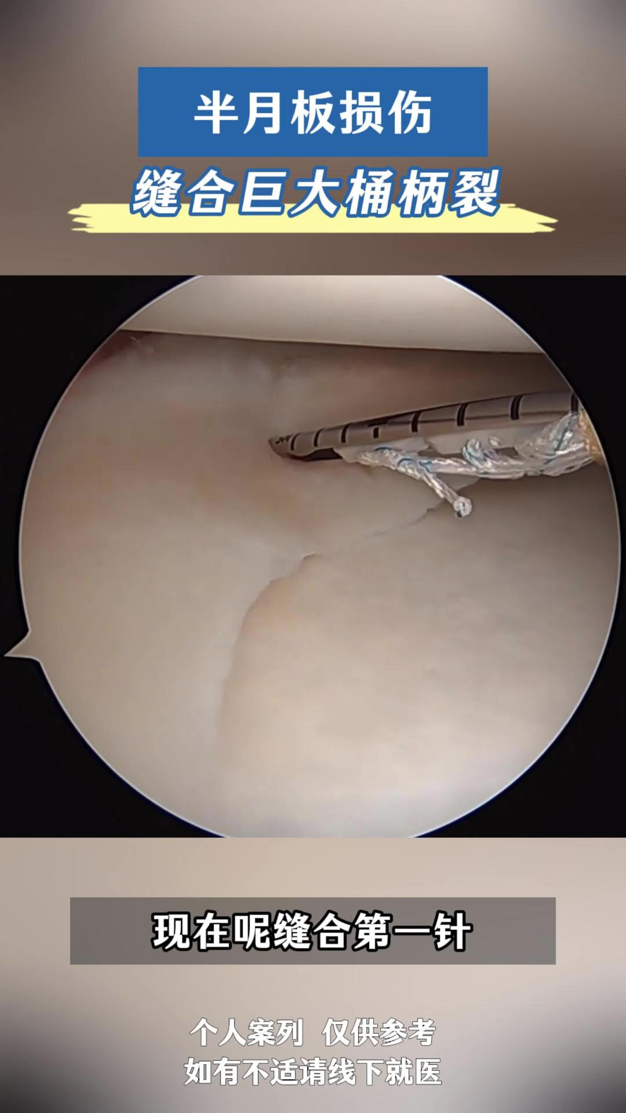 半月板损伤缝合巨大桶柄裂 注意了！！