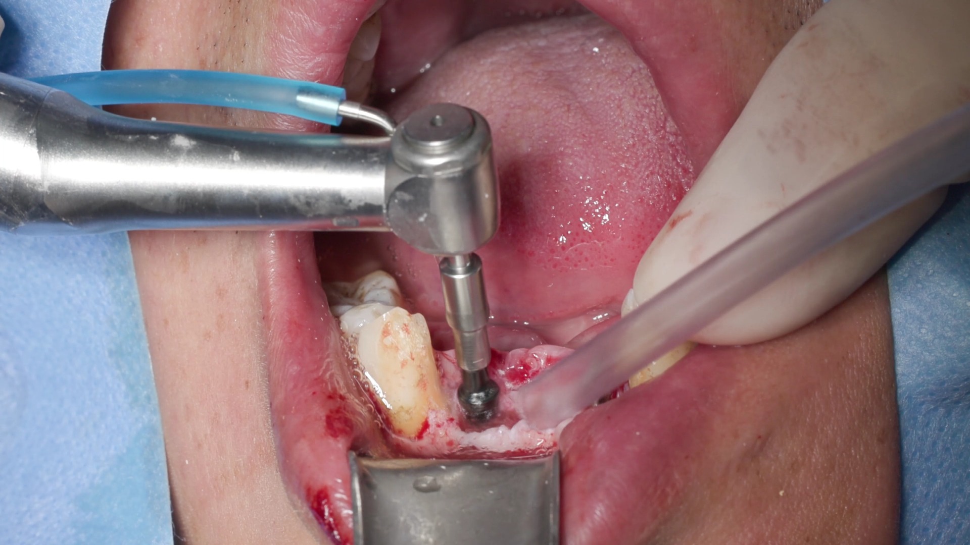 9月3日下前牙局部即刻负重
