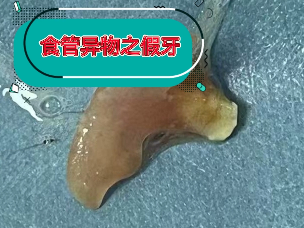 食管异物之假牙。本院消化内科门诊位于门诊楼2楼27诊室。病