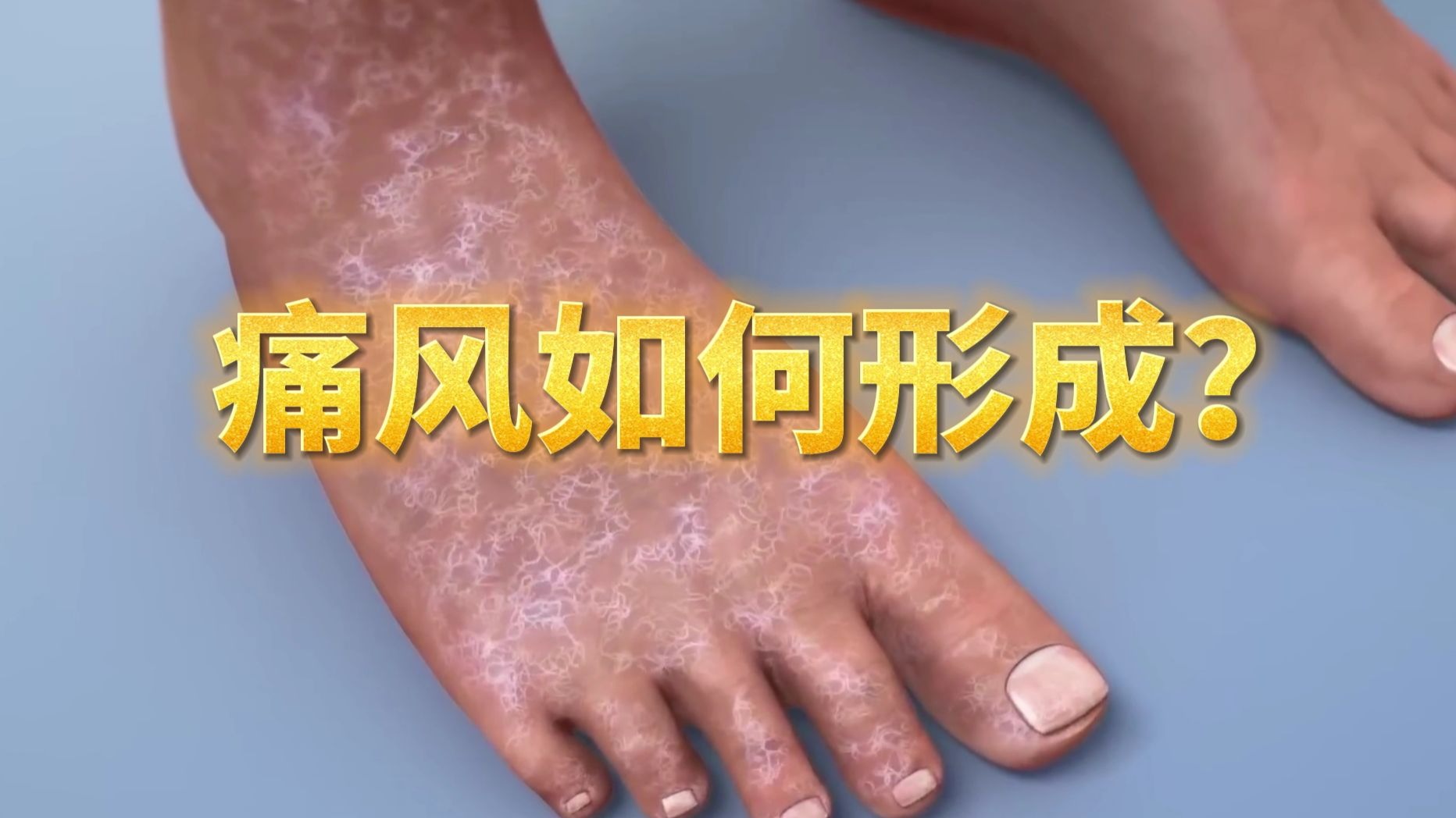 痛风是怎么形成的?平时怎么做才能会降低痛风的出现呢?