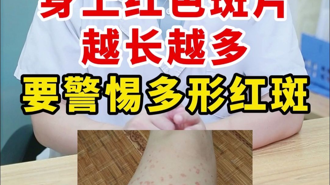 身上红色斑片越长越多 要警惕多形红斑