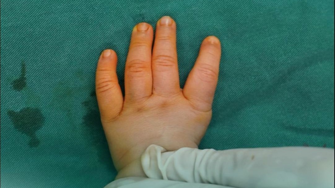 大拇指没有长出来怎么办？我们给孩子创造出拇指功能