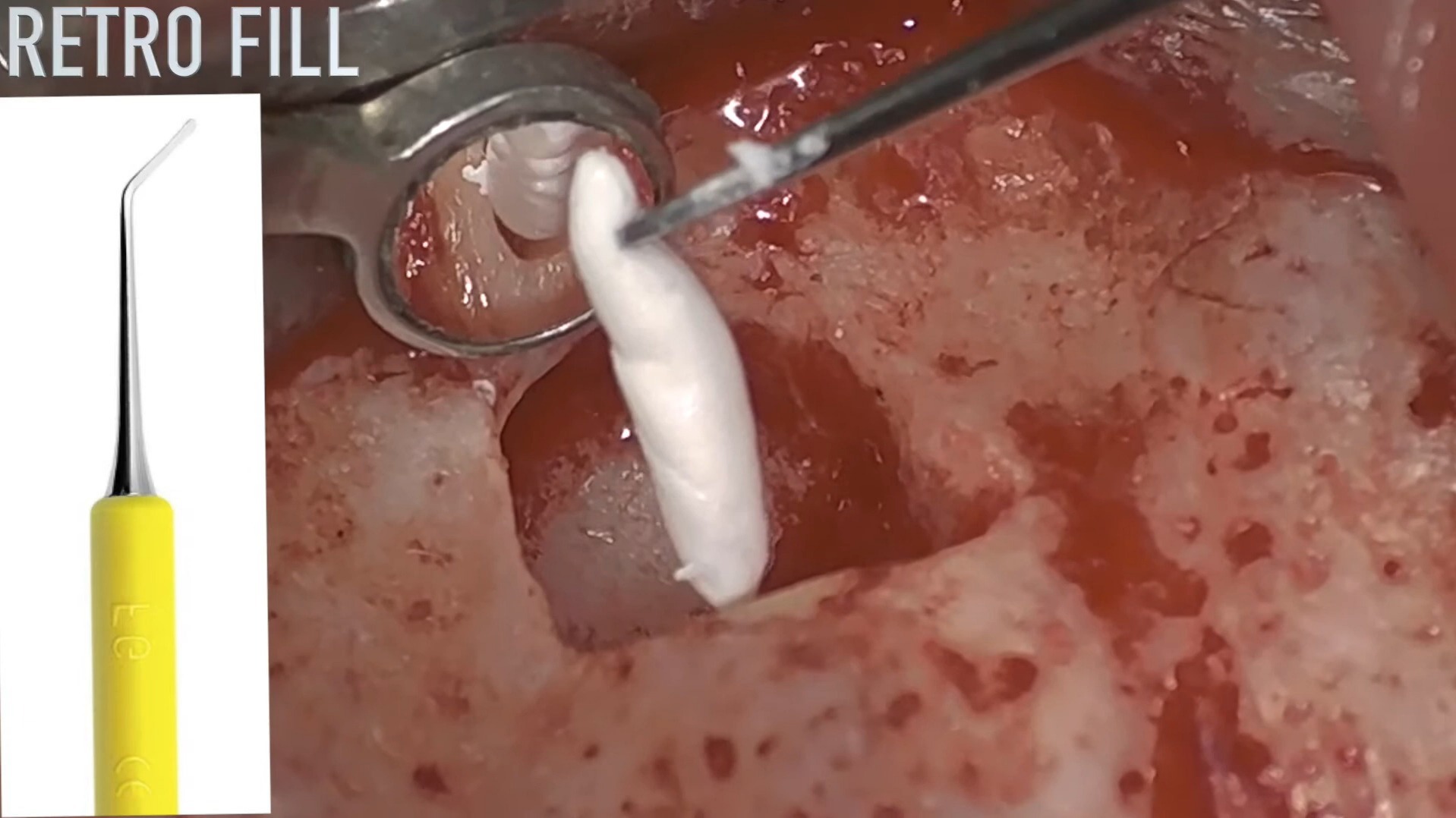 左上 2 apical surgery