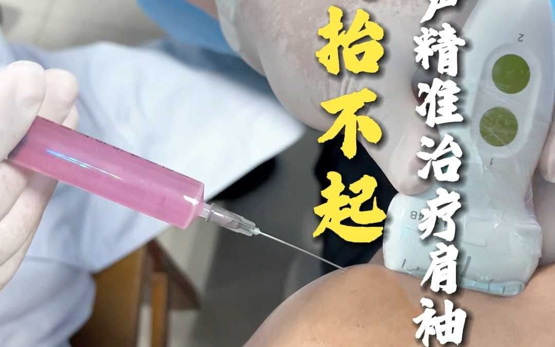 患者胳膊抬不起 超声精准定位治疗肩袖损伤