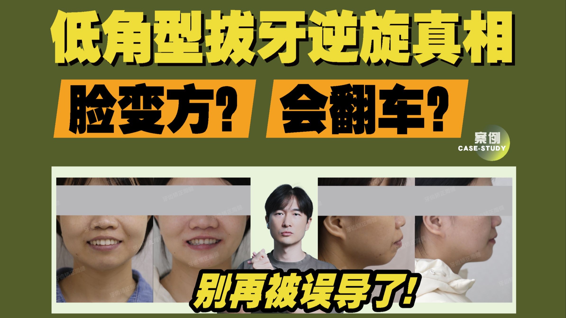 低角拔牙逆旋脸会变方？现实打脸！