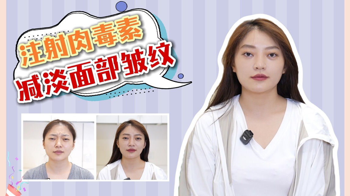 苦相脸两大仇敌——皱眉纹、抬头纹，一支肉毒全搞定！
