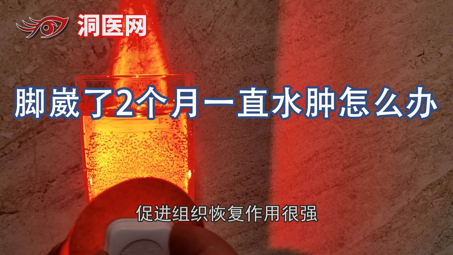 脚崴了2个月一直水肿怎么办