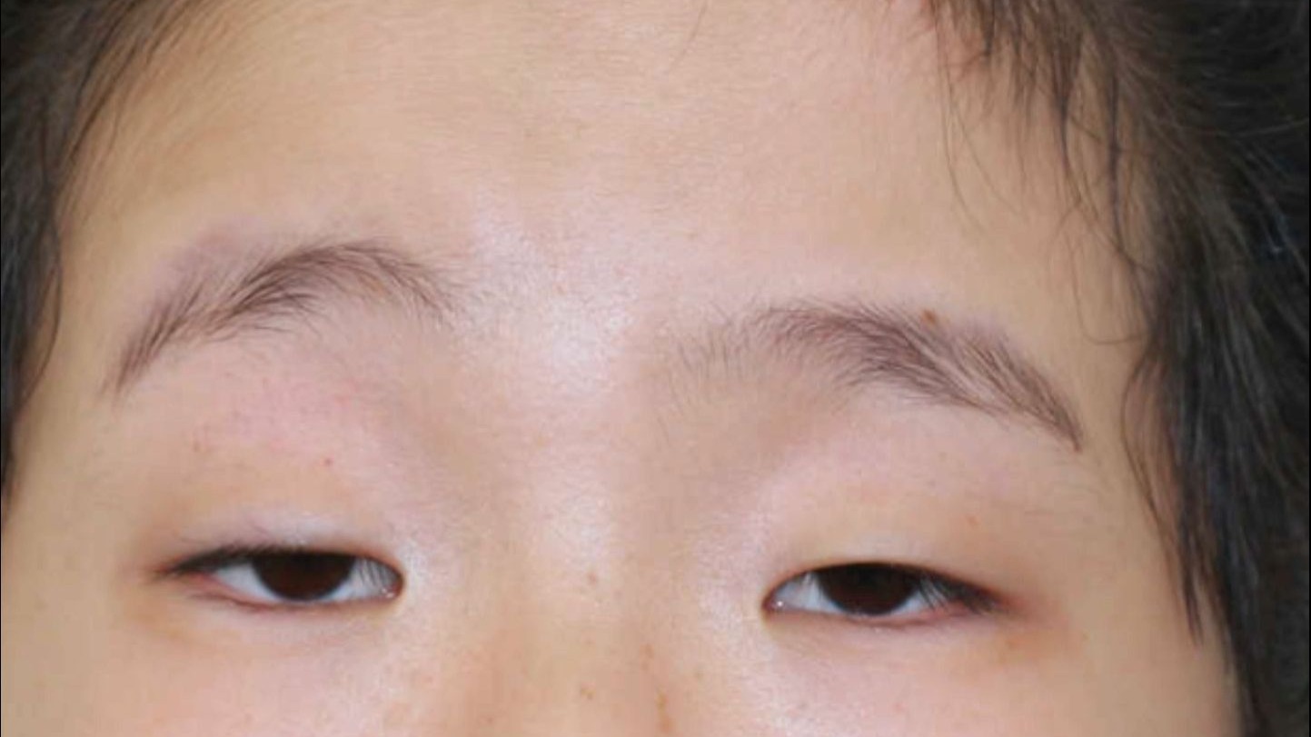 小眼综合征，会遗传三代？