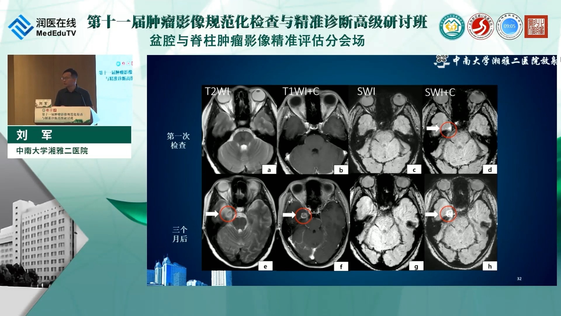 浅析脑转移瘤的早期诊断策略-刘军