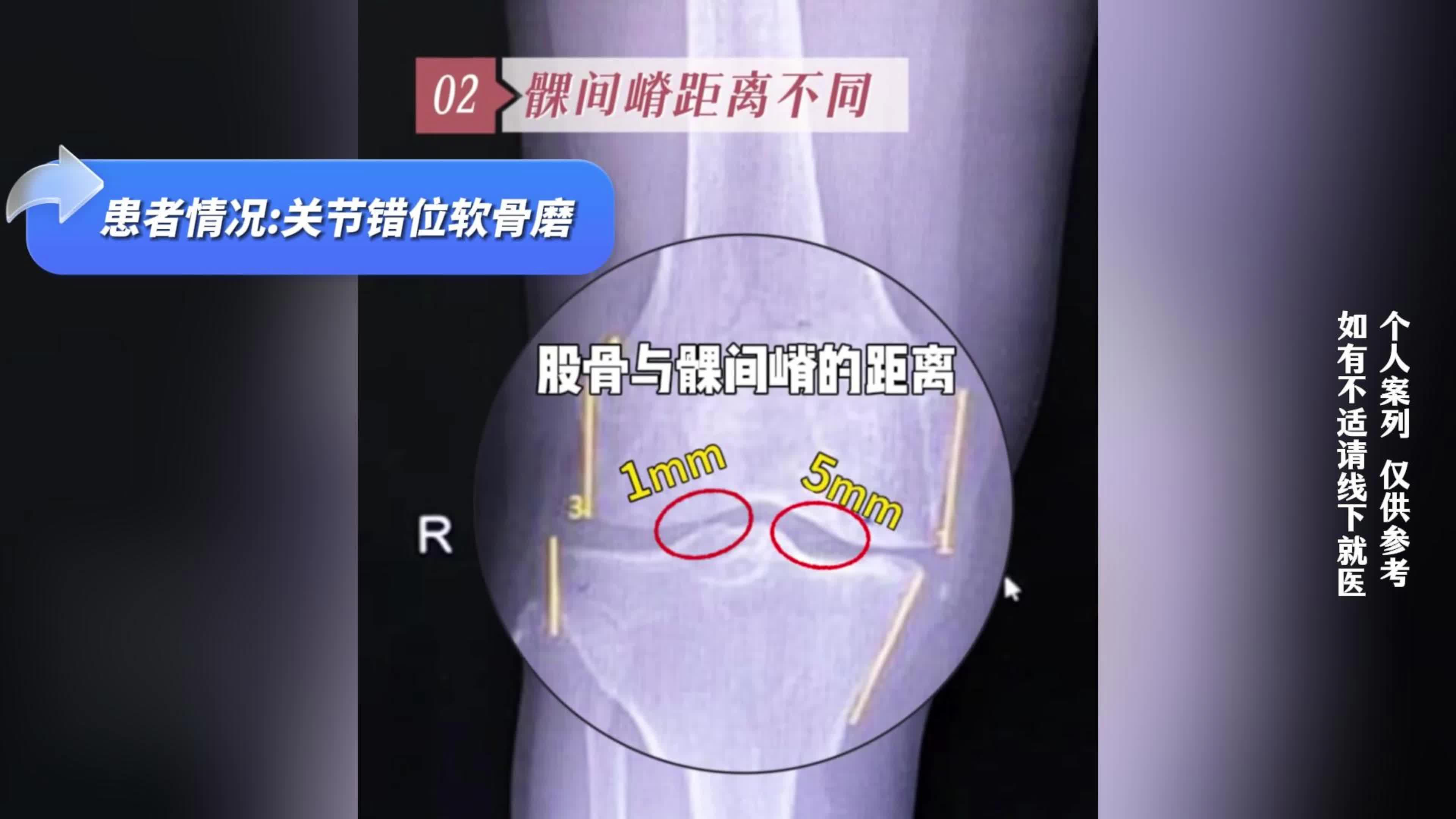 患者情况:关节错位软骨磨！！注意看~