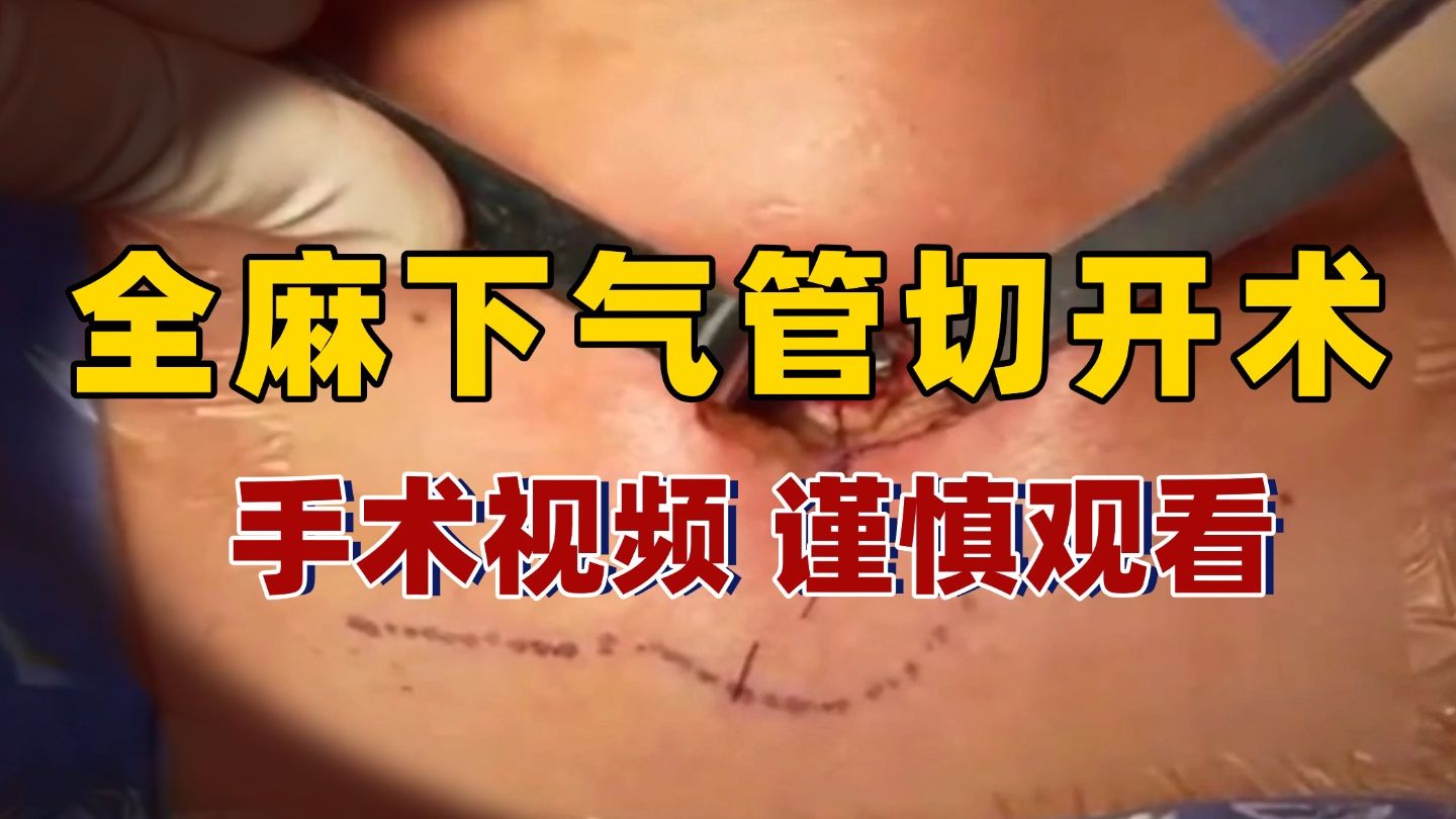 【耳鼻咽喉手术视频 谨慎观看】全麻下气管切开术