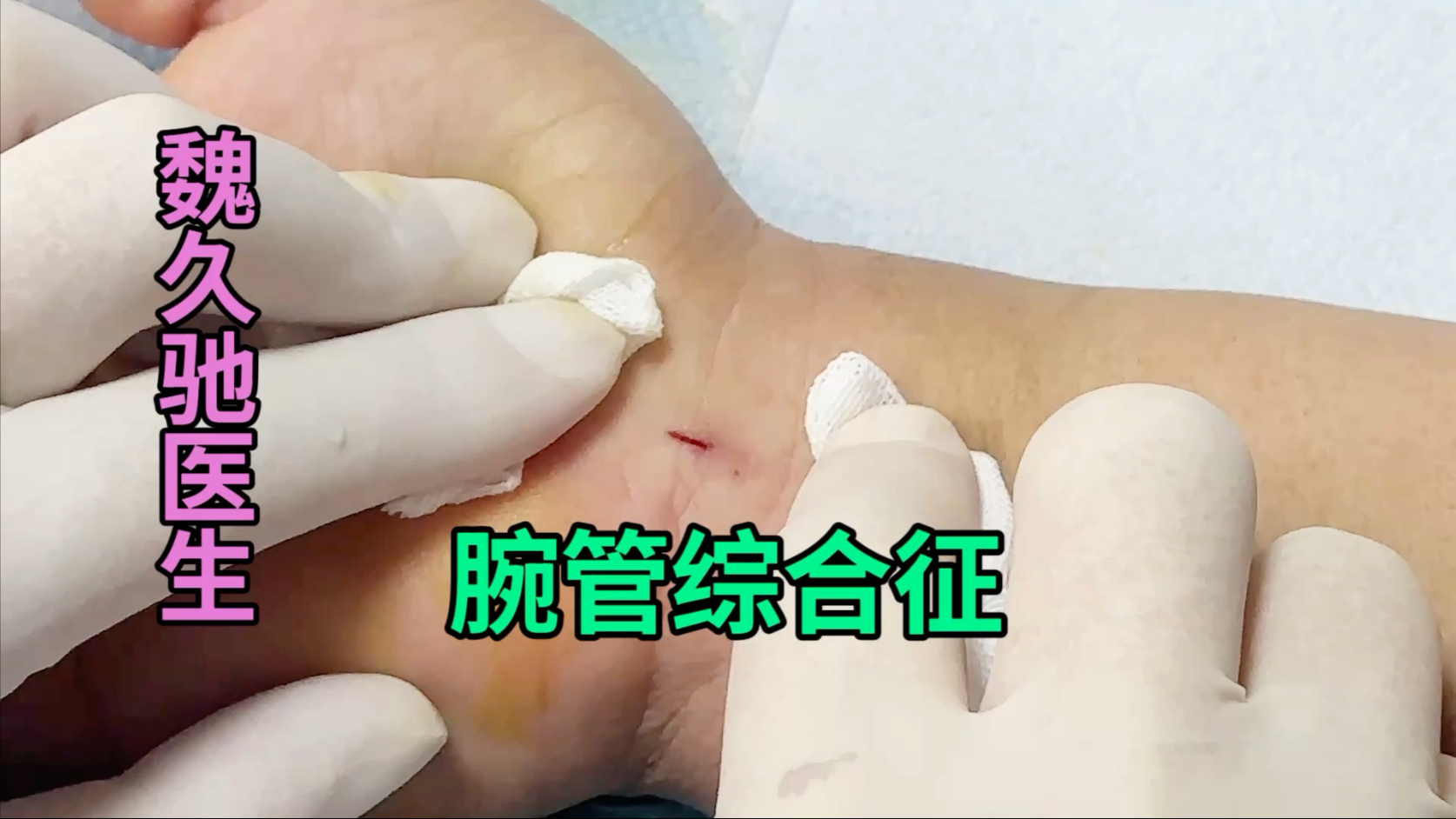 微创手术治疗腕管综合征不需要缝合，不留疤痕