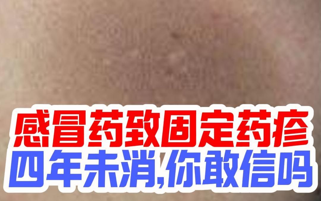 感冒药致固定药疹四年未消,你敢信吗