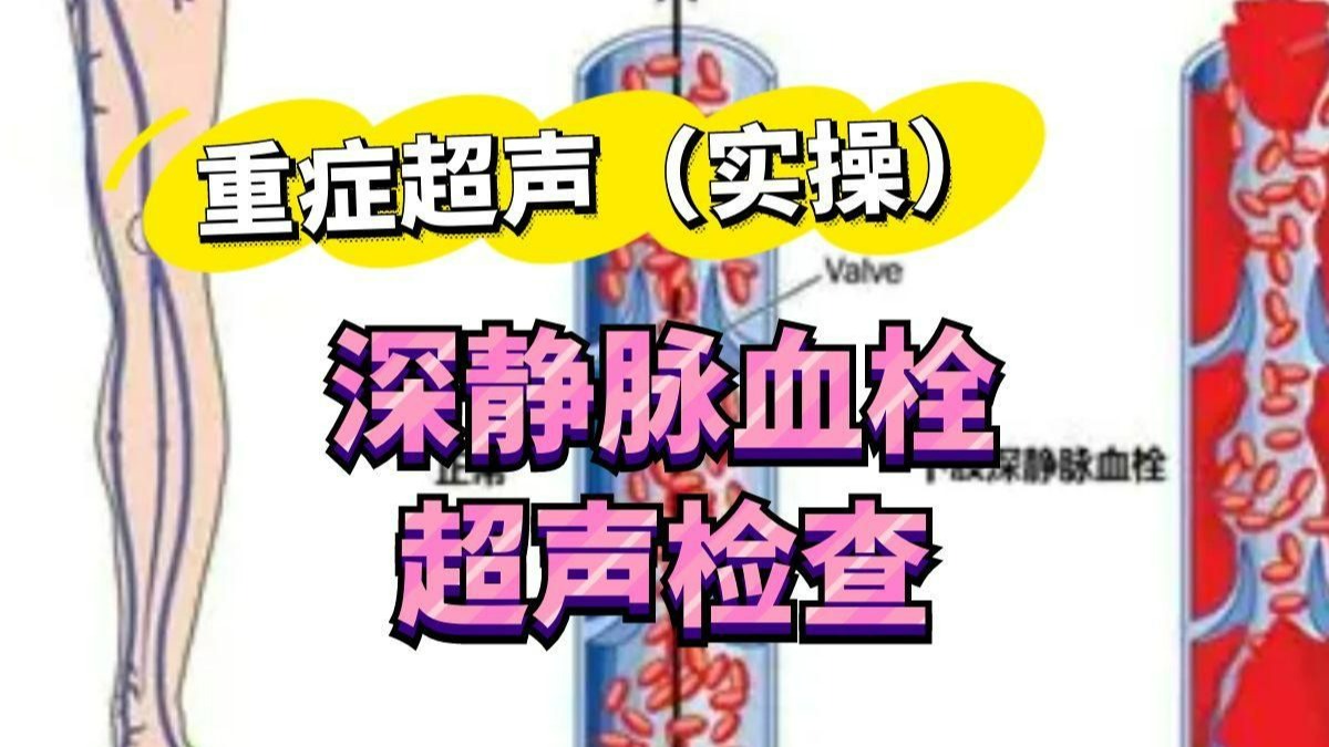 重症超声-血管超声-深静脉血栓