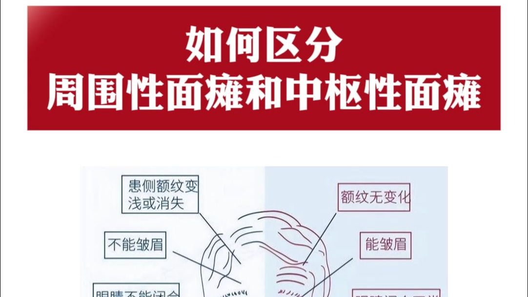 如何区分周围性面瘫和中枢性面瘫