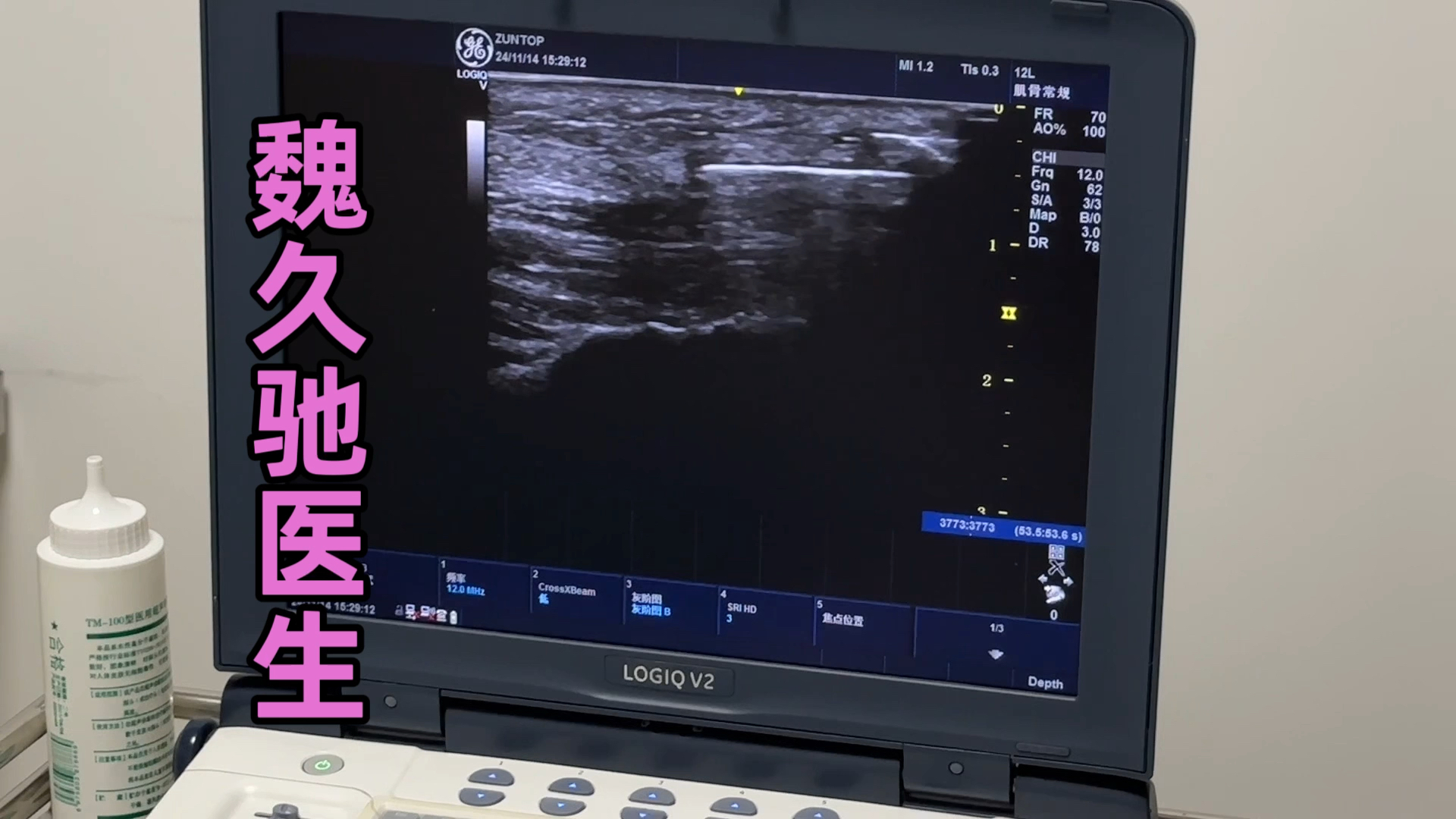 腕管综合征怎么治疗创伤小恢复快？