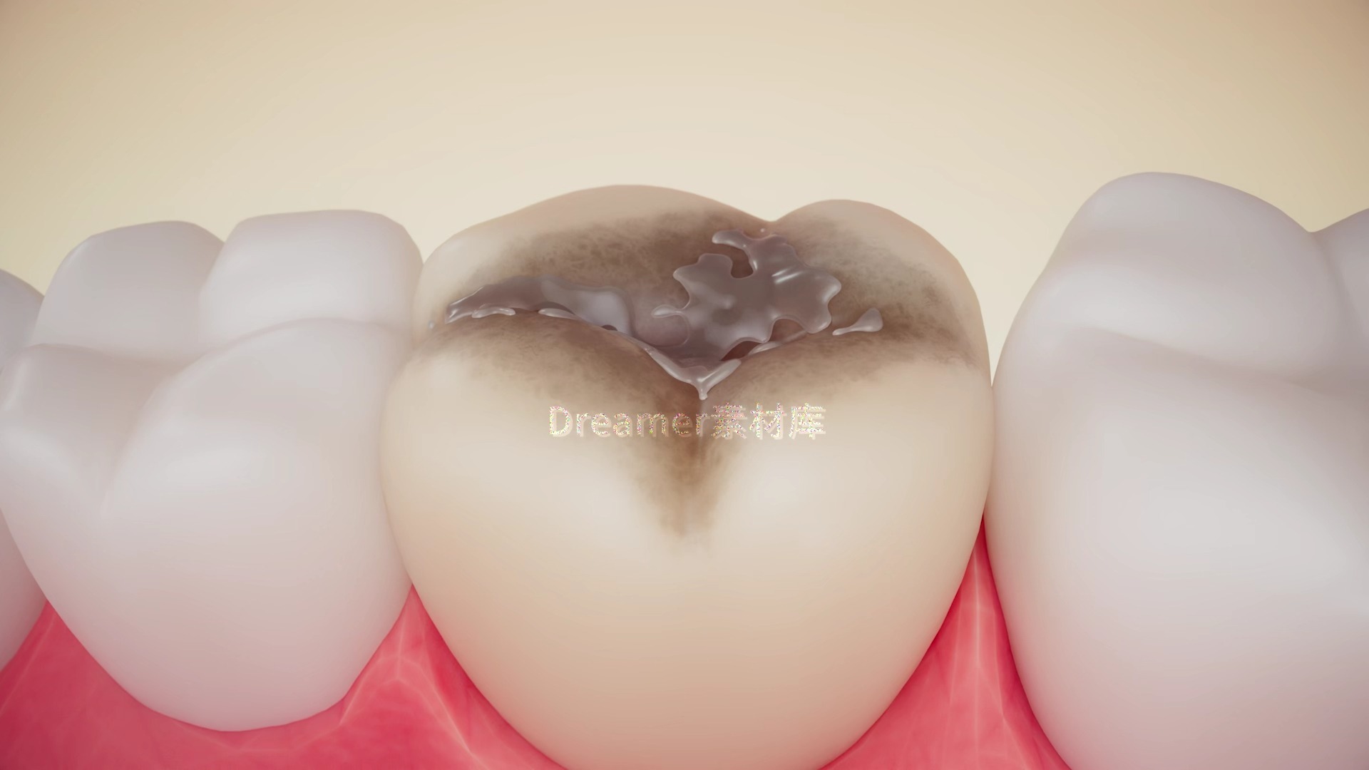 龋齿发展过程牙齿健康虫牙