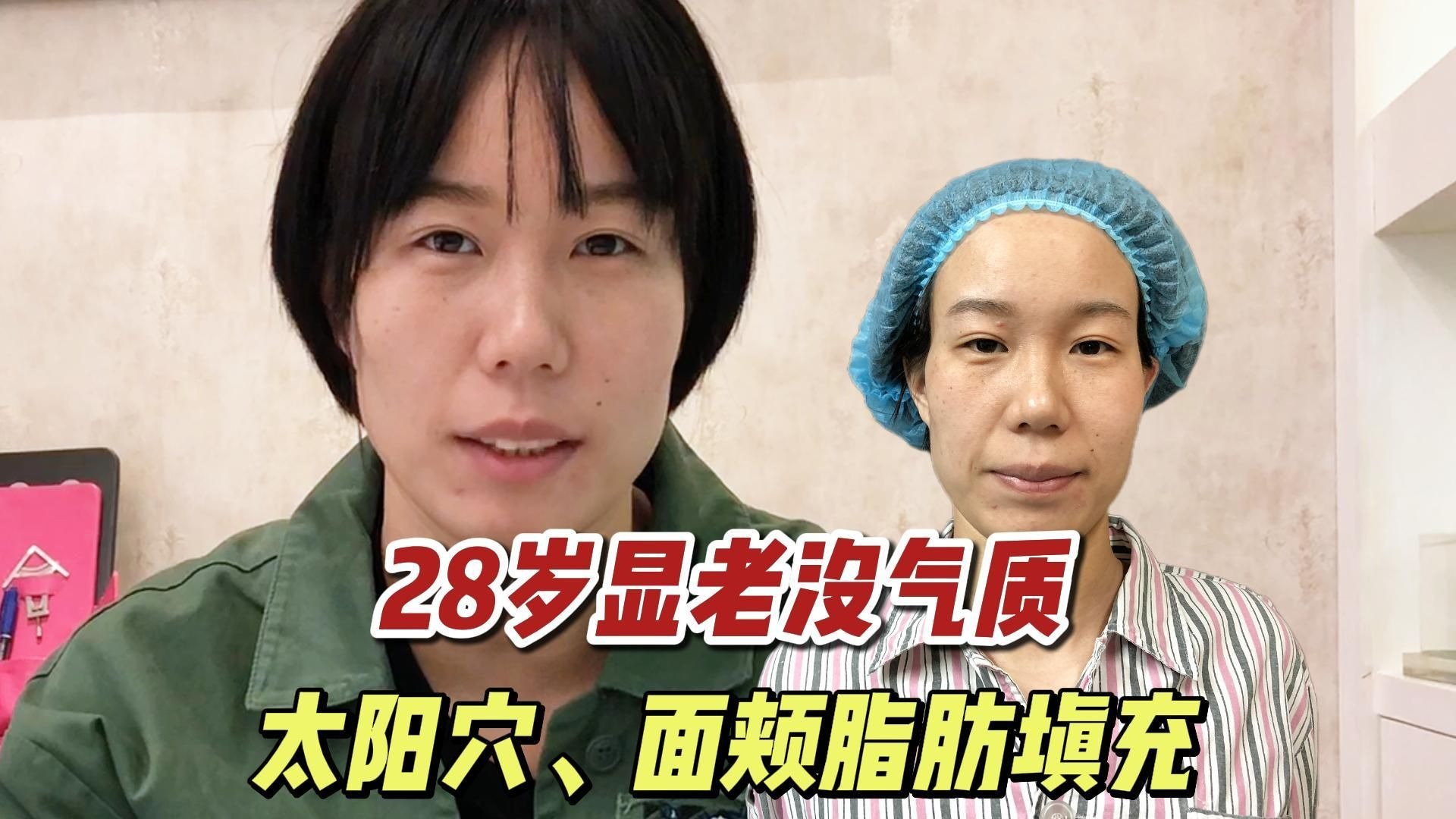 28岁显老没气质，太阳穴、面颊填充后变化大不大？