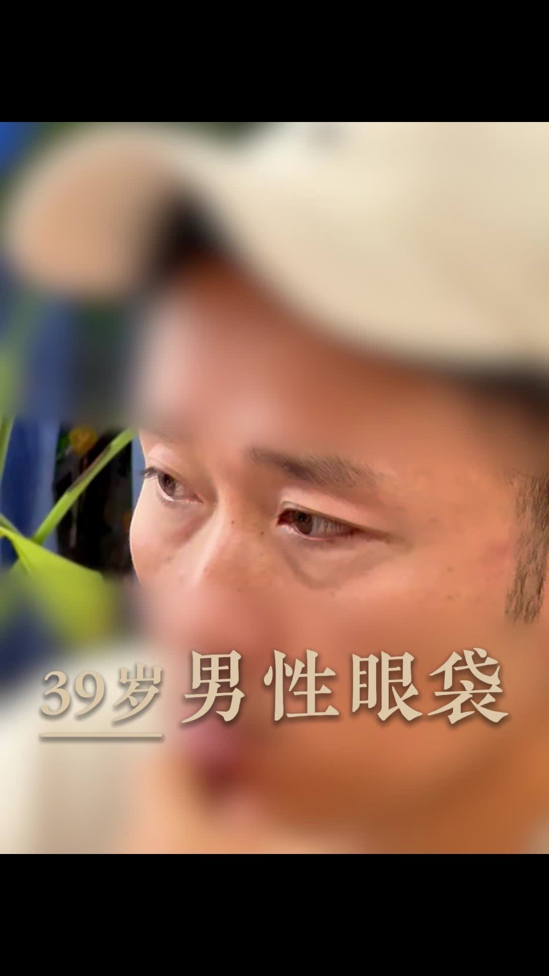 男性脂肪性眼袋，这样做不留疤痕
