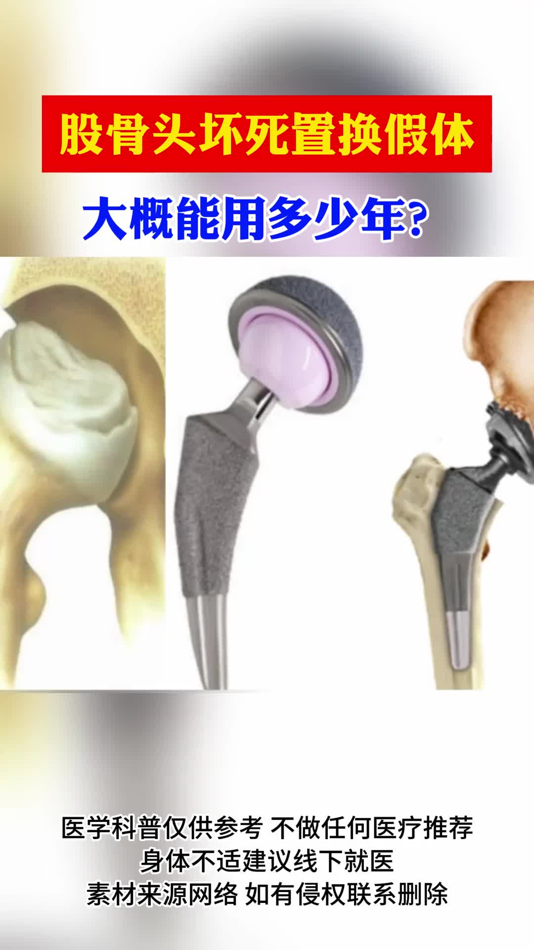 股骨头坏死置换假体大概能用多少年
