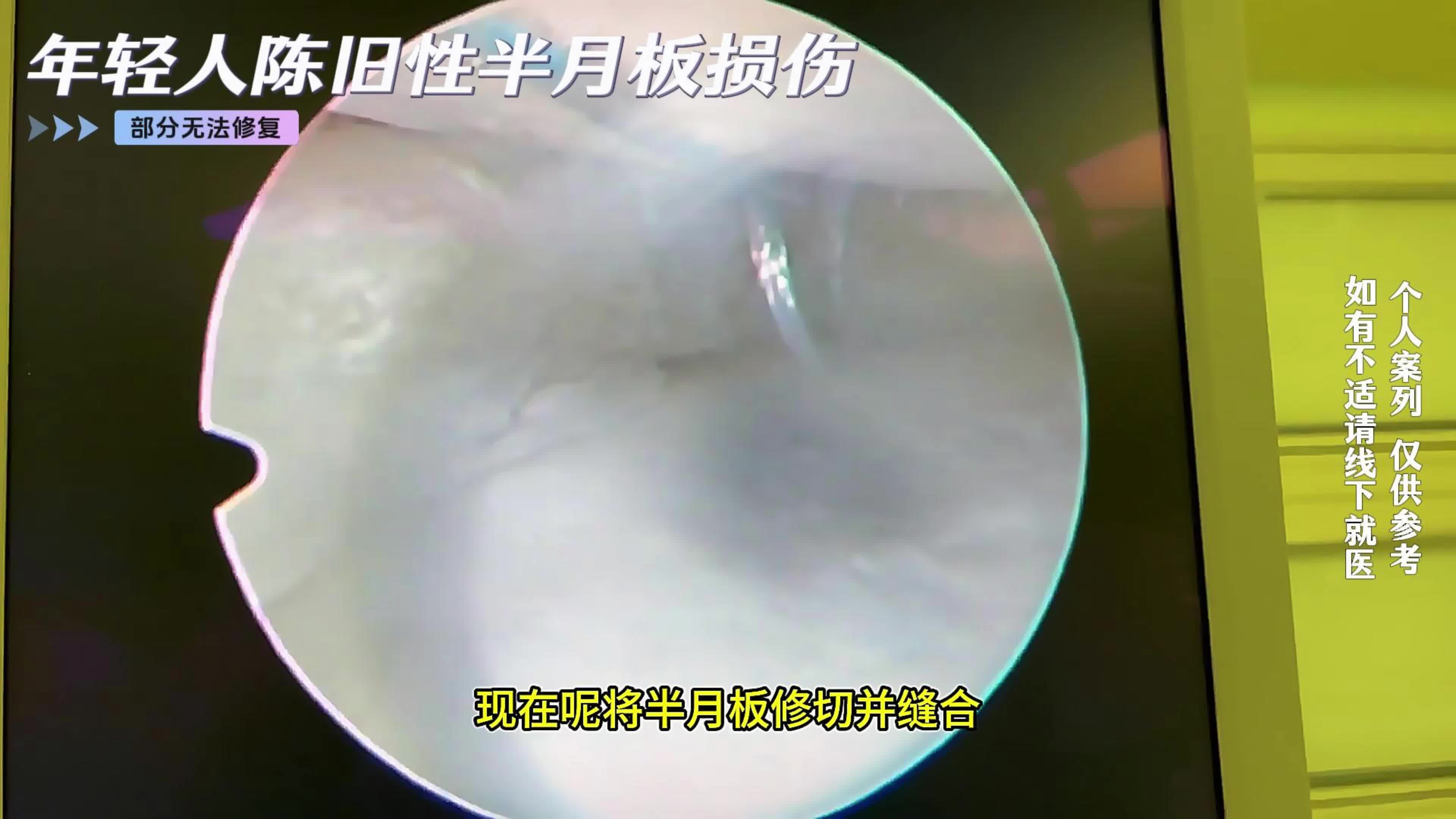 年轻人陈旧性半月板损伤 部分无法修复！！