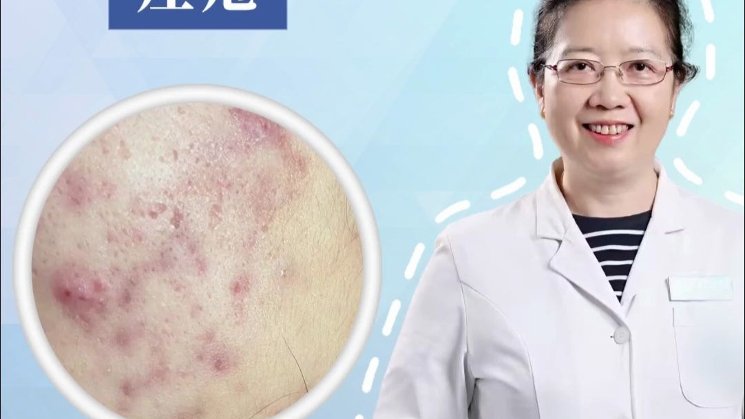经常长痤疮 这些食物要拒绝