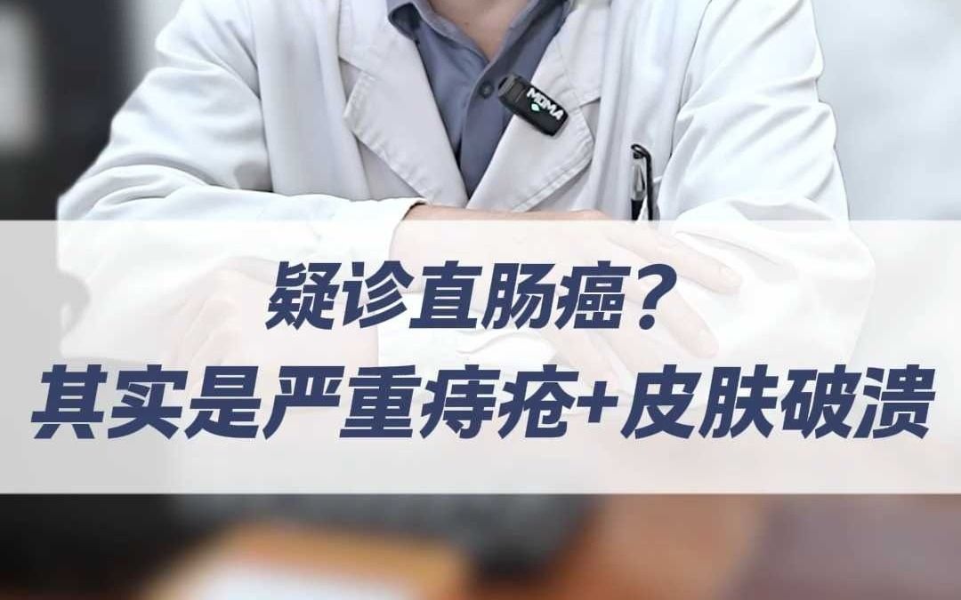 疑诊直肠癌？其实是严重痔疮+皮肤破溃