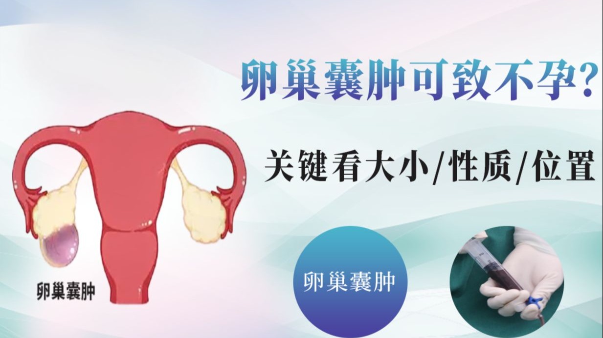 卵巢囊肿可致不孕？关键看大小/性质/位置！