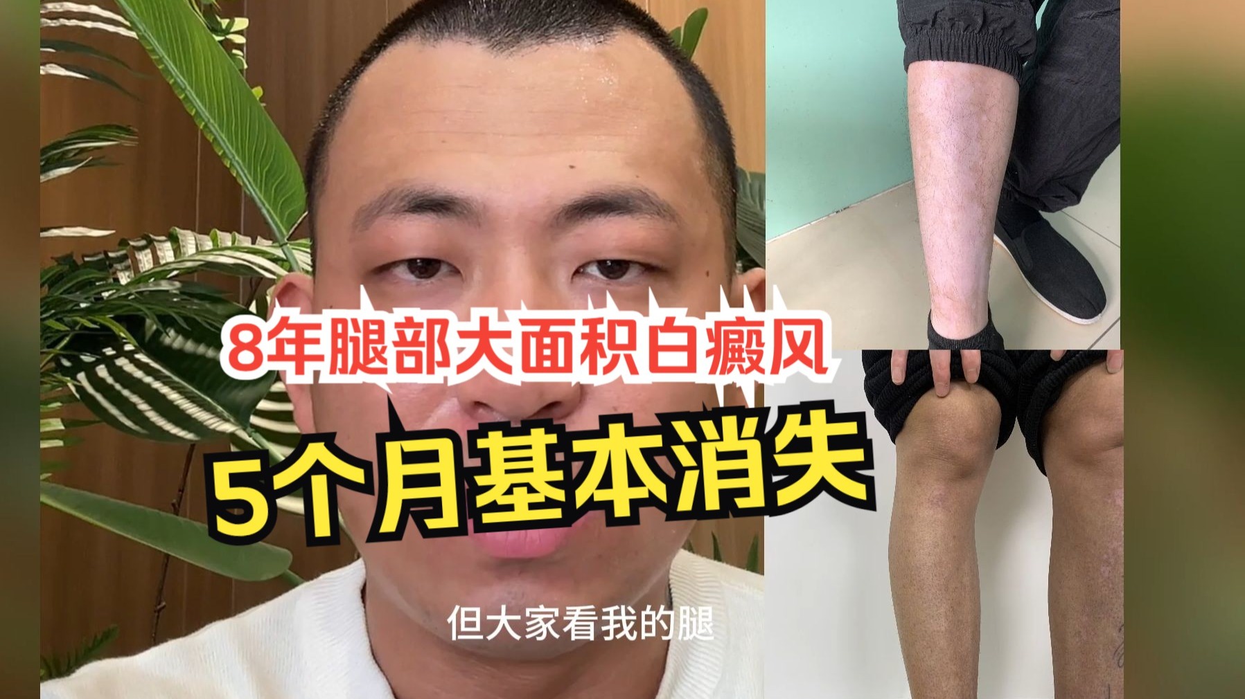 白白分享：8年腿部大面部白癜风，五个月基本消失