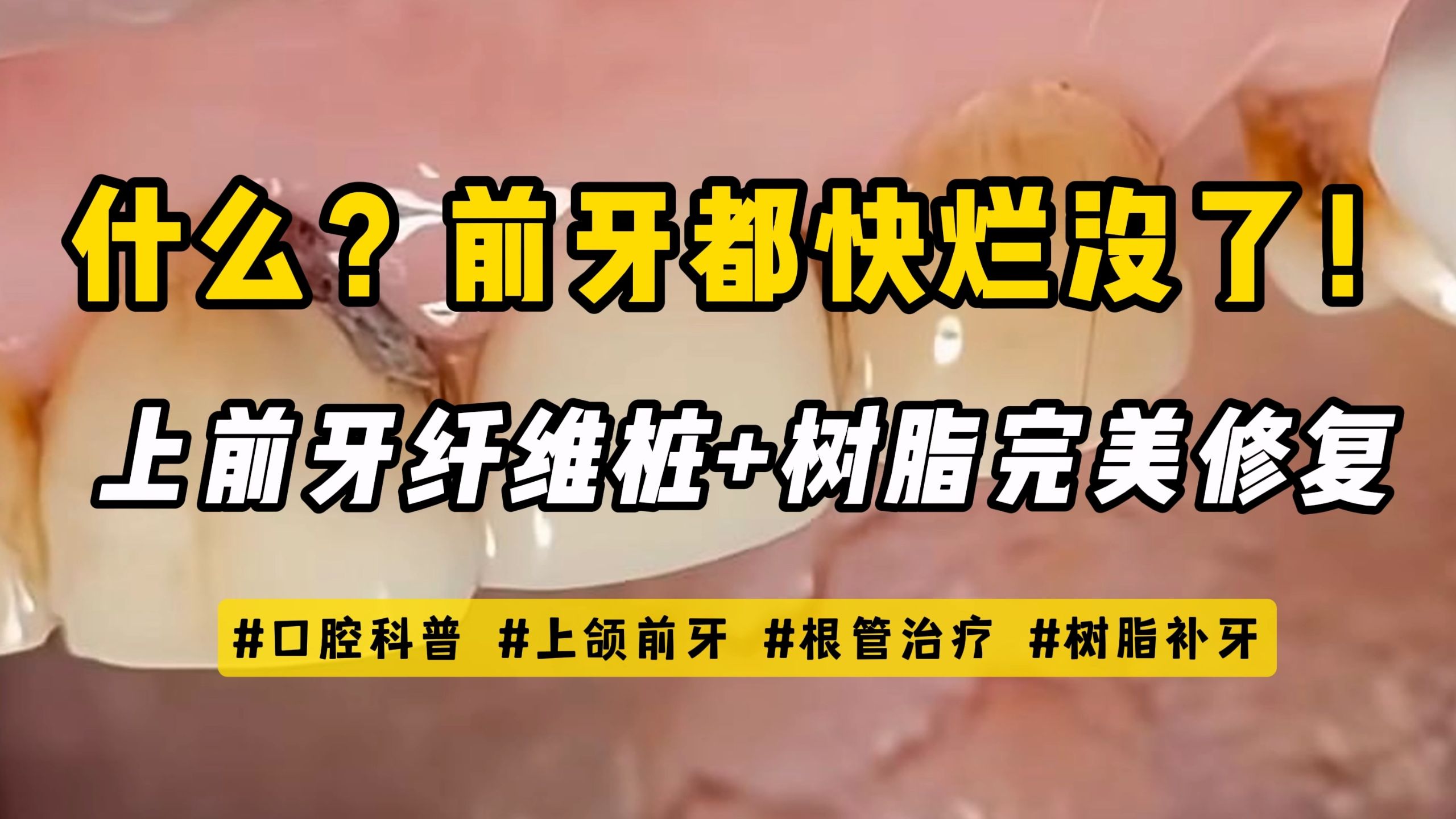 前牙都快烂没了!上前牙纤维桩+树脂完美修复!