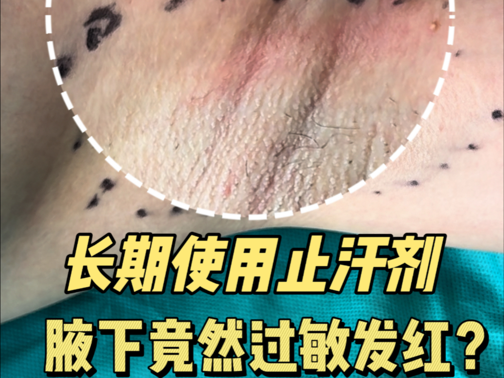 长期使用止汗剂，腋下竟然过敏发红？