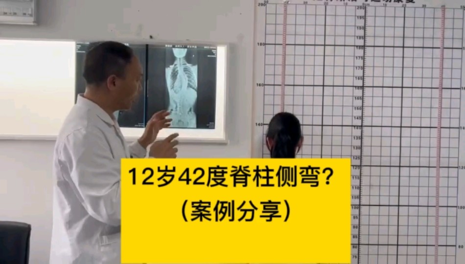 12岁42度脊柱侧弯？