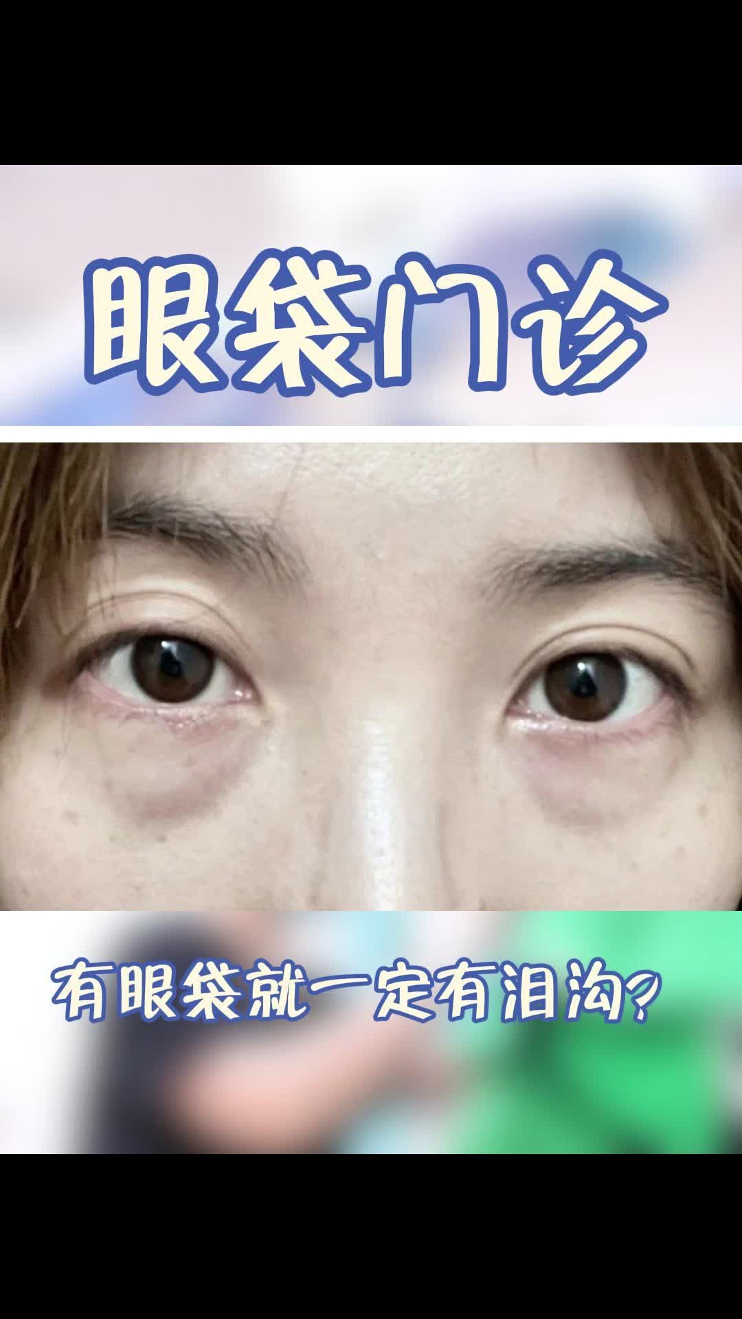 有眼袋就一定有泪沟？