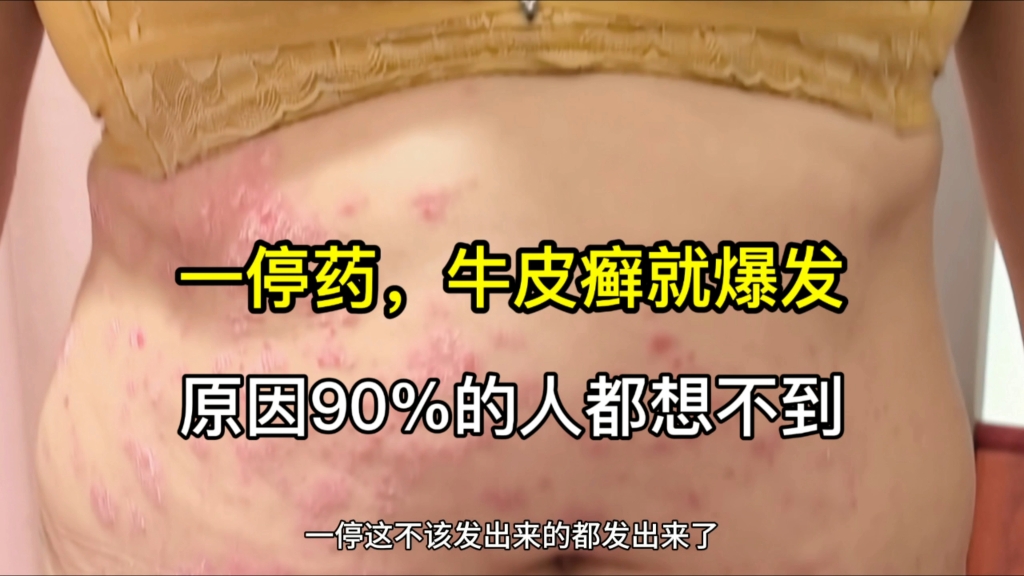 一停药牛皮癣就爆发，原因90%的人都想不到