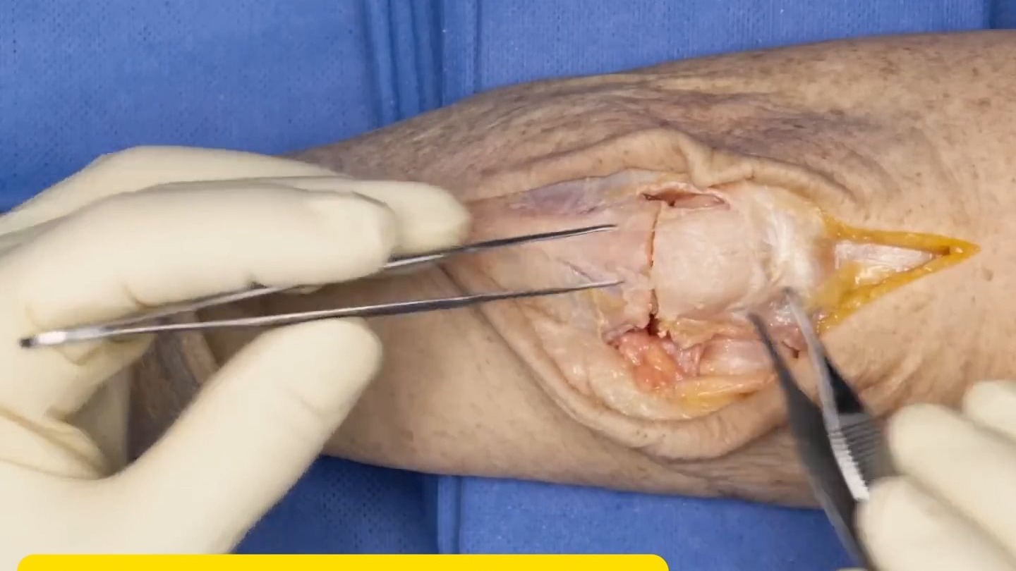 鹰嘴骨折的环扎张力带固定术