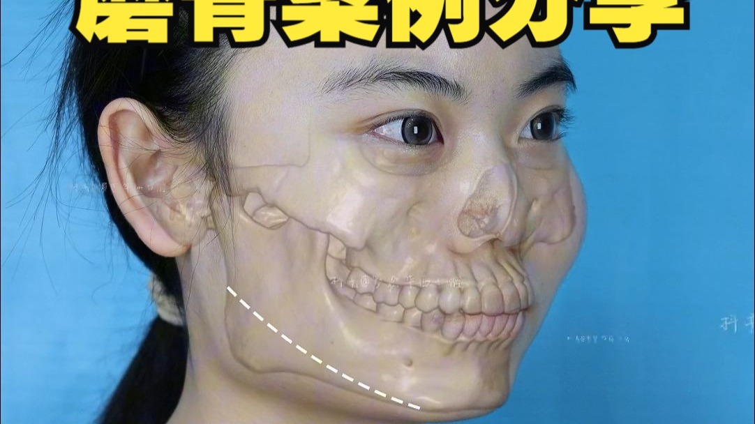 磨骨案例分享，因脸型问题被取外号