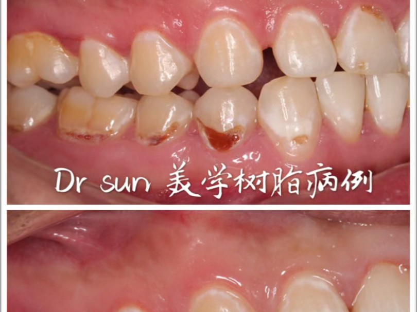 爱喝可乐的小伙子，美学树脂补牙4颗