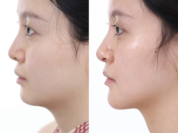 peek下巴修复即刻，侧脸精致感拉满