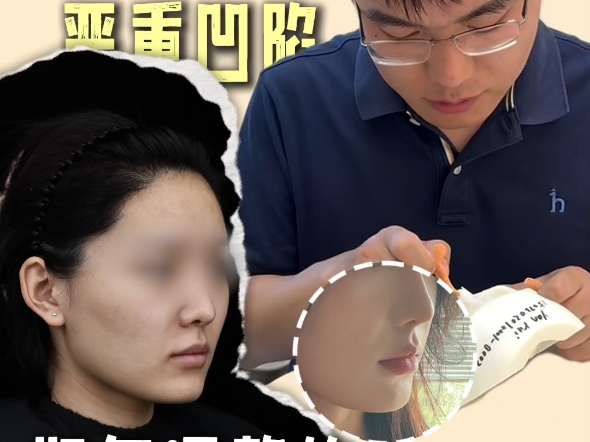 3d打印peek鼻基底，拯救面部严重凹陷