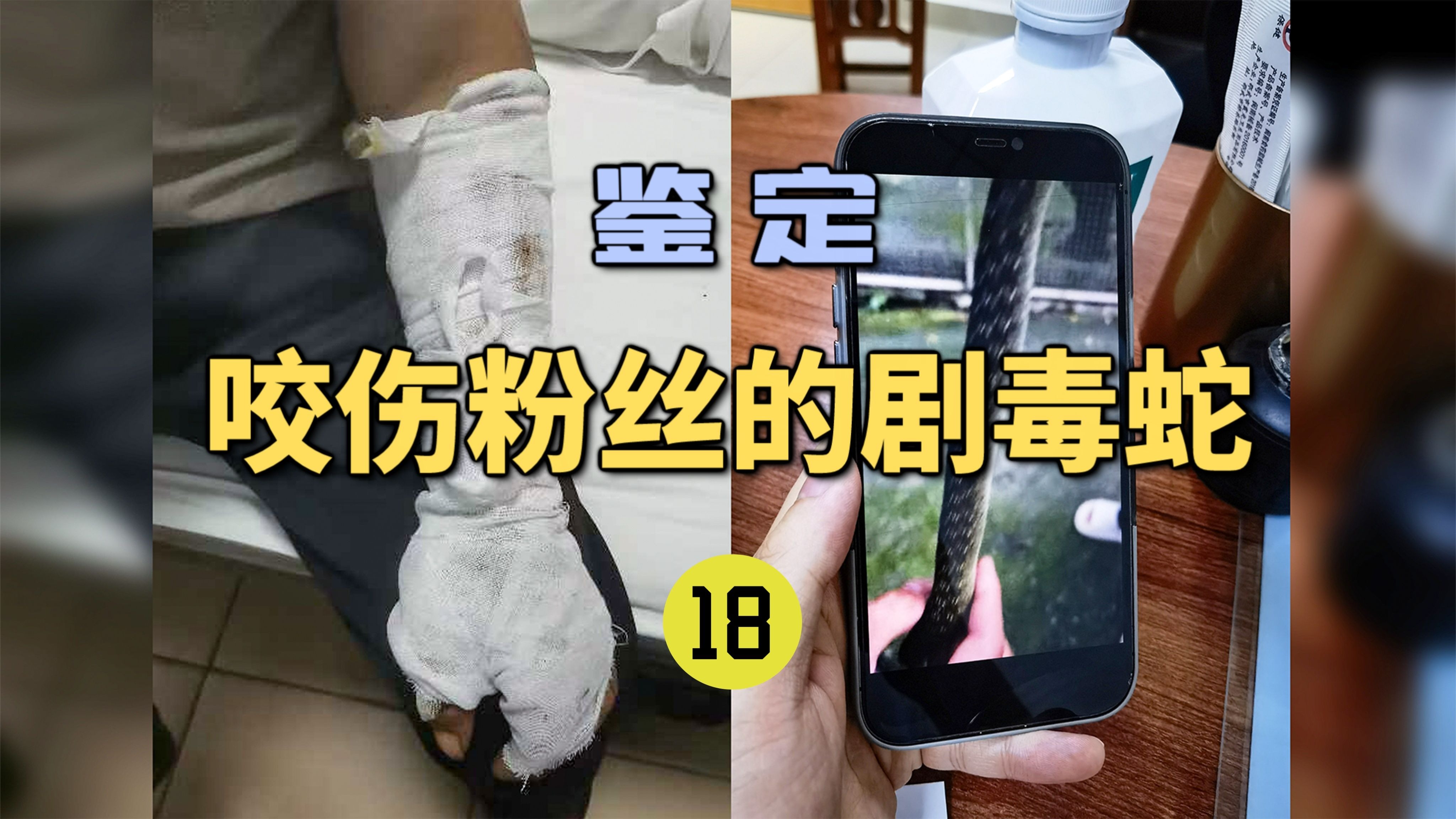 鉴定咬伤粉丝的毒蛇(18)老人被毒蛇咬伤不肯去医院？家属劝导后