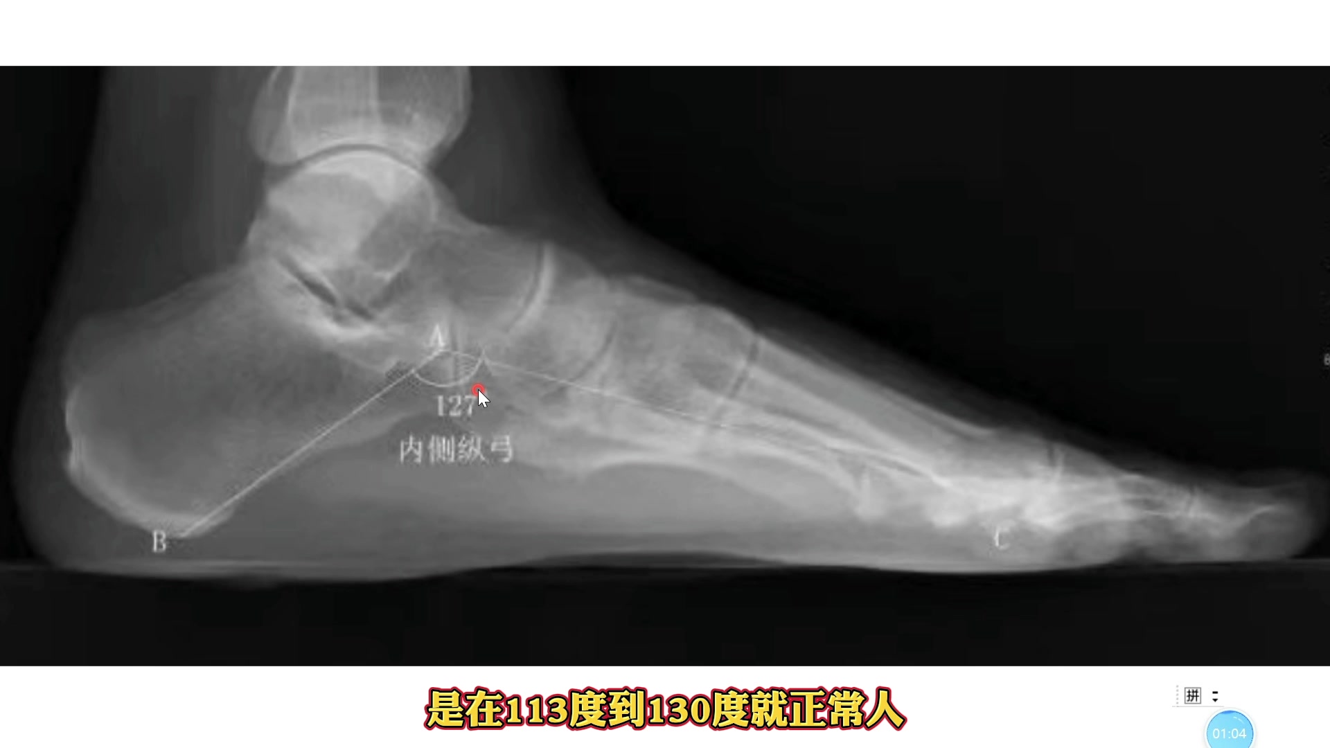 扁平足X线影像如何诊断？专科医生教你测量方法！