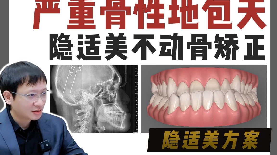 【隐适美动画方案】重磅‼正颌级别地包天！纯矫正能做到什么程