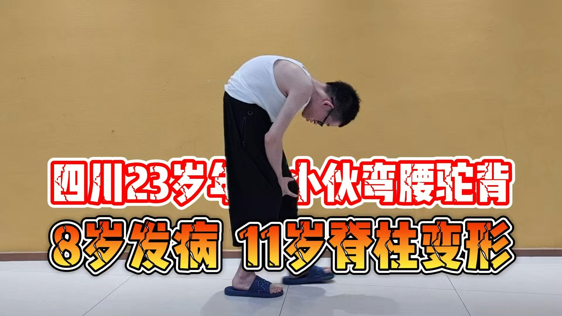 四川强直驼背，8岁发病，11岁脊柱变形，23岁弯曲成“大虾”
