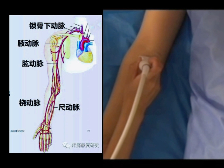 上肢动脉超声检查